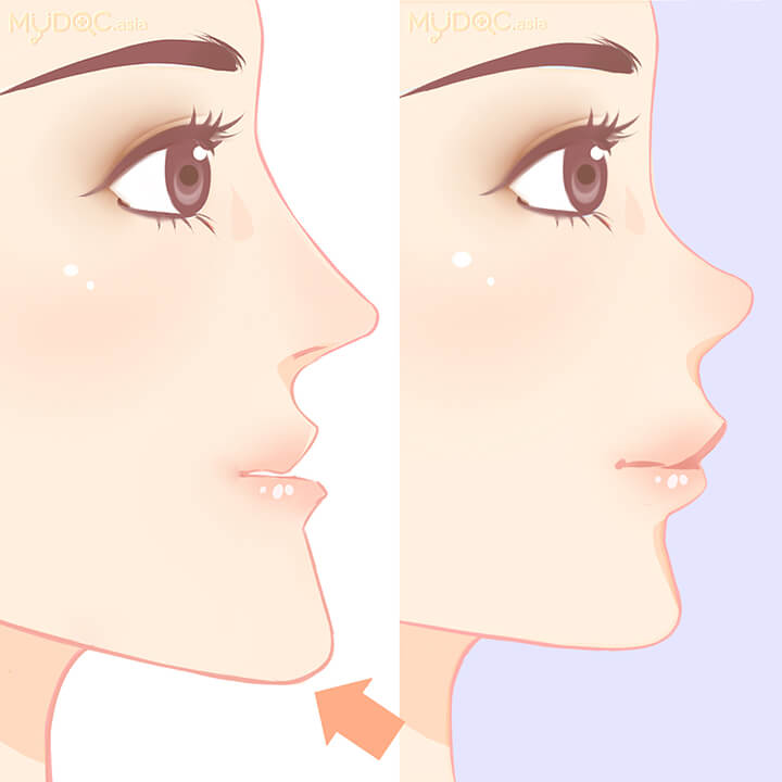 Single Jaw Surgery