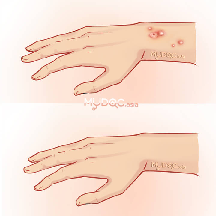 Rawatan Kulit Lesion (bintik kecil)