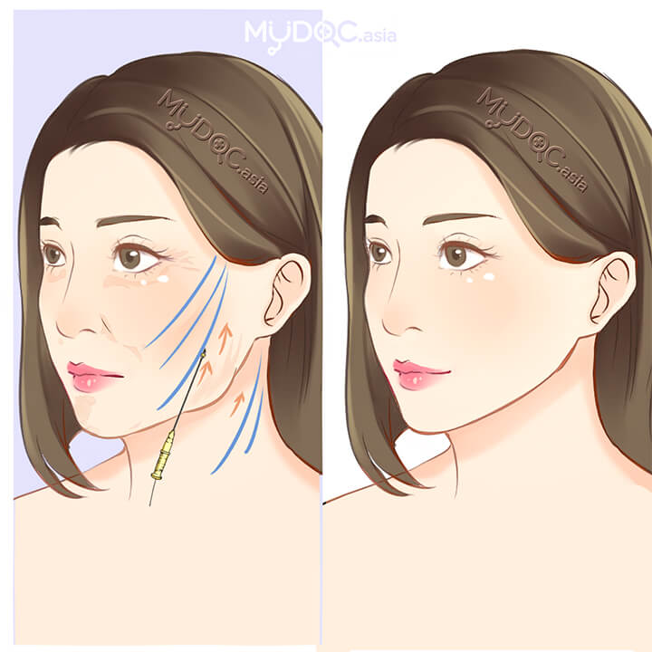Skin Lifting