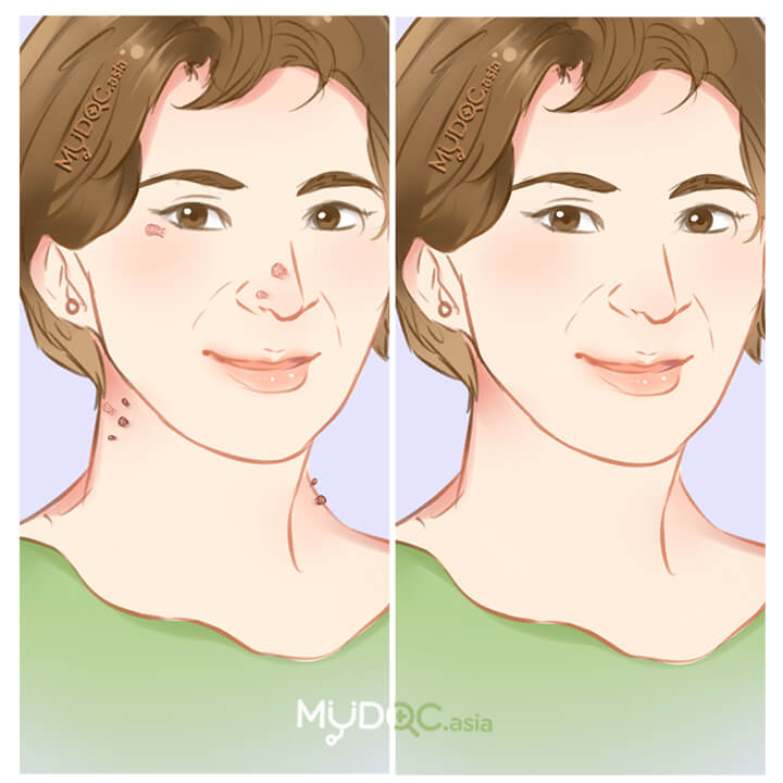 Skin Tag Removal