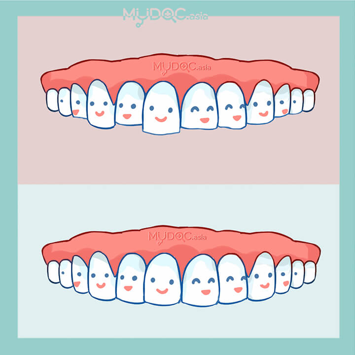 Teeth Contouring and Reshaping