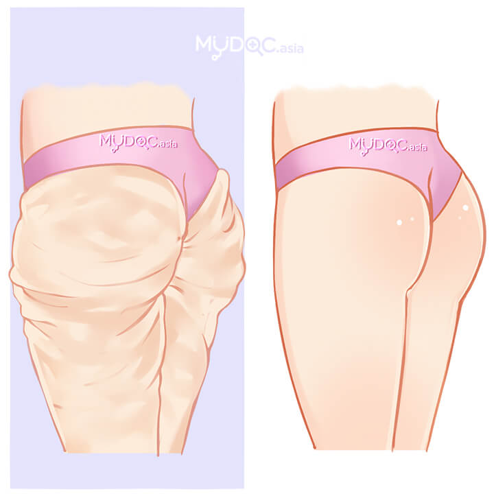 Thigh Lift