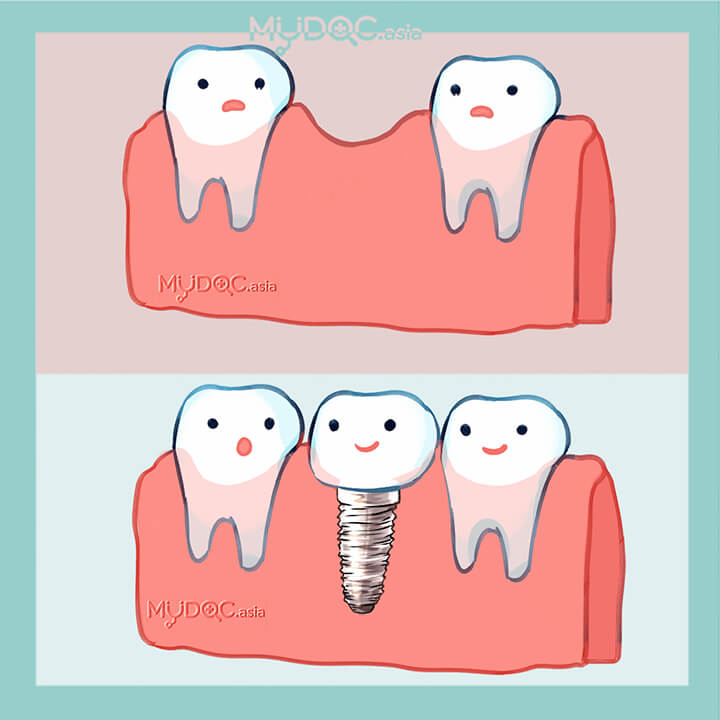 Titanium Dental Implant