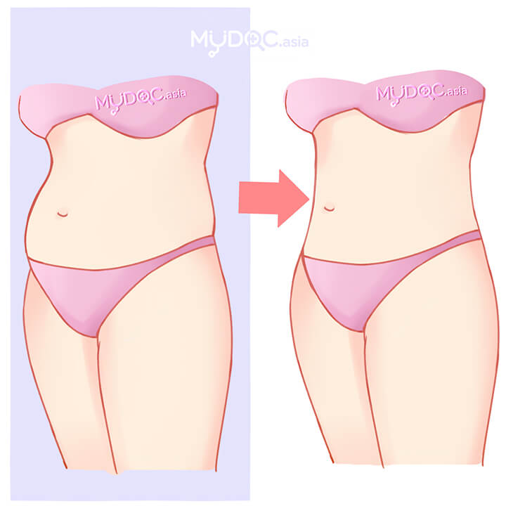 lipo tummy tuck price lipo tummy tuck price