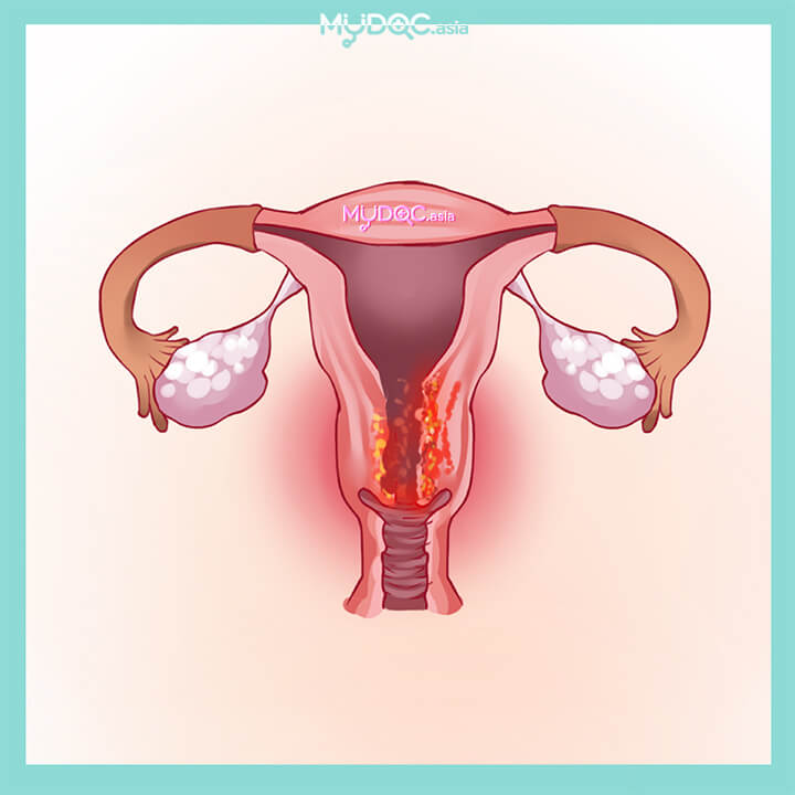 Diagnosis & Perawatan Kanker Rahim
