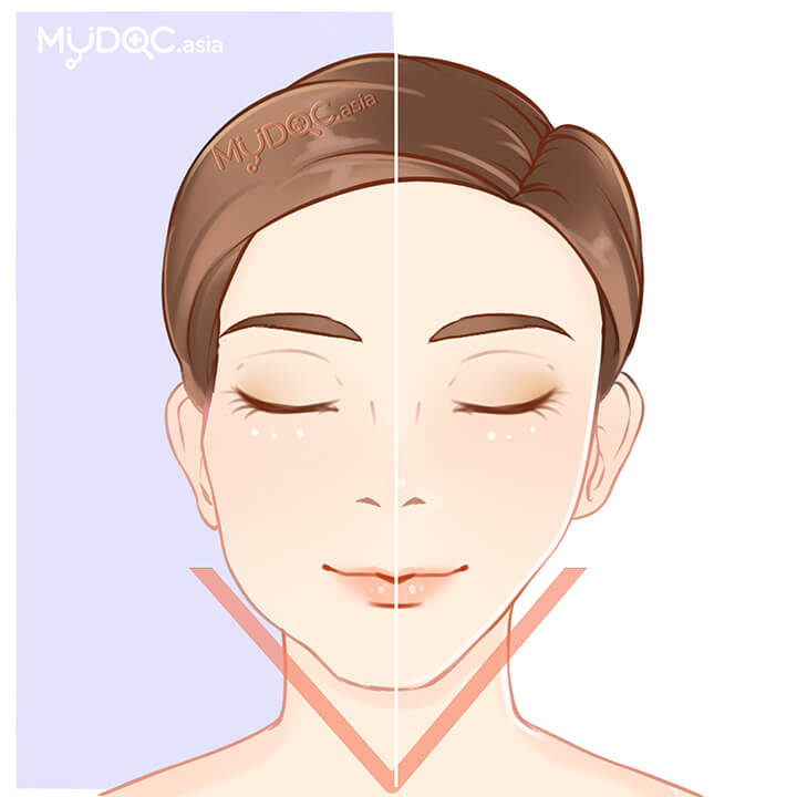V-Shape Face Treatment
