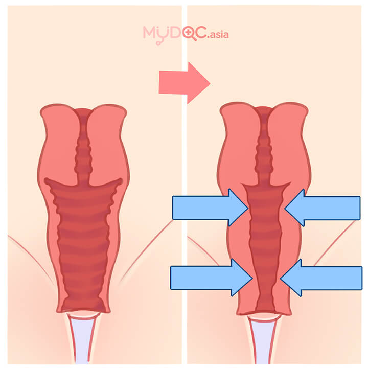 Vaginoplasty (Vaginal Tightening)