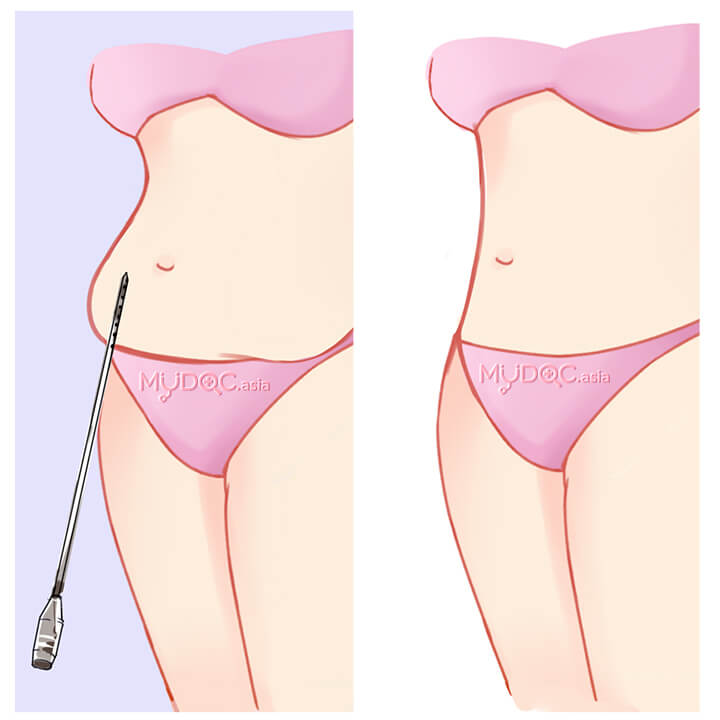Vaser Liposuction
