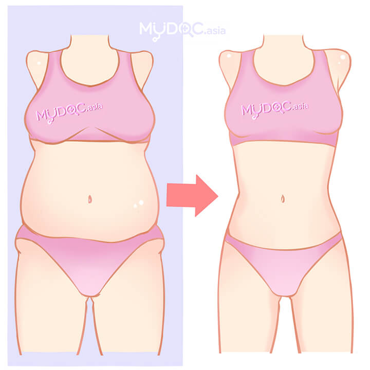 Weight Loss Surgery